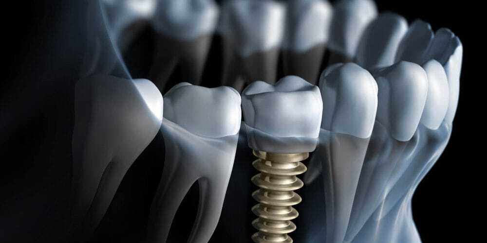 Dental Implants Last Forever