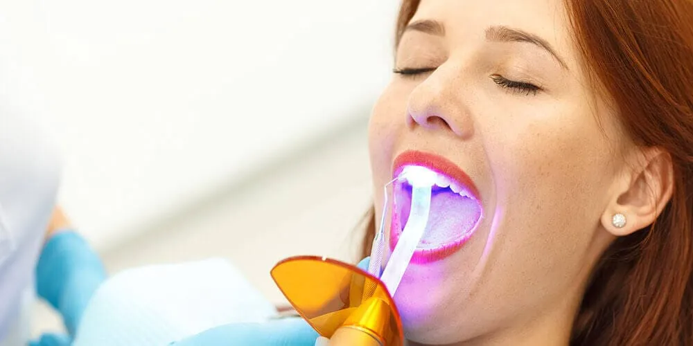 Dental Bonding Dental Bonding