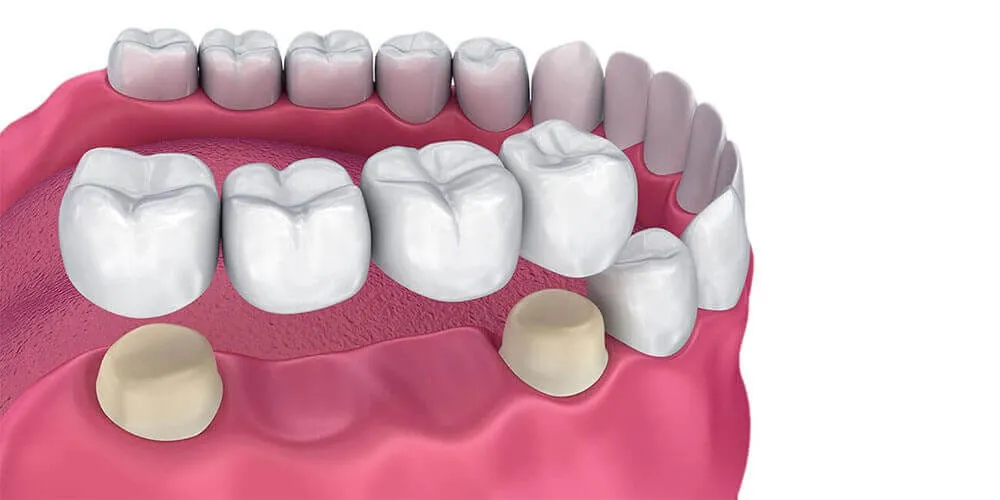 Dental Bridges