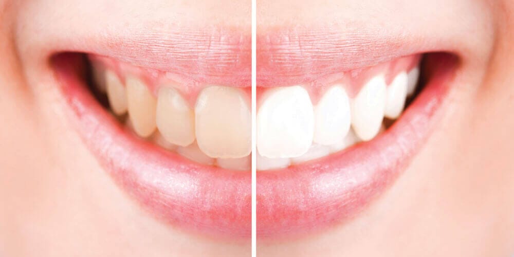 Teeth Whitening