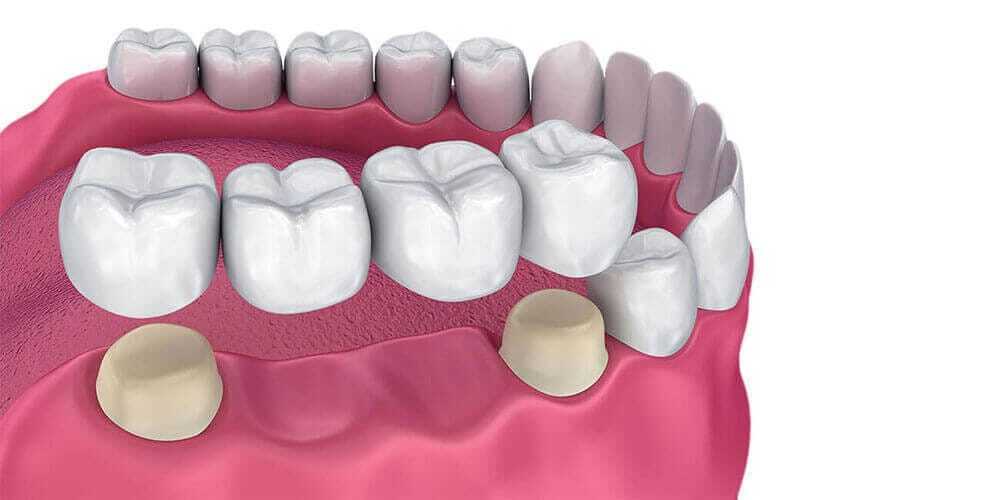 Dental Bridges Dental Bridges