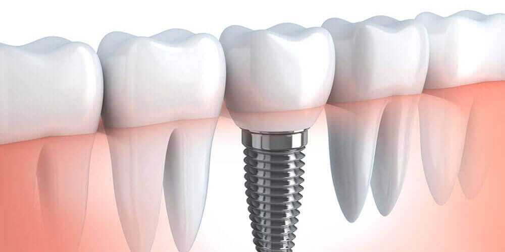 Dental Implants Dental Implants