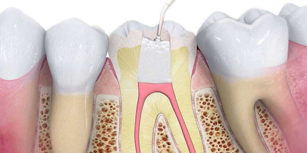 Root Canal Treatment Root Canal Treatment