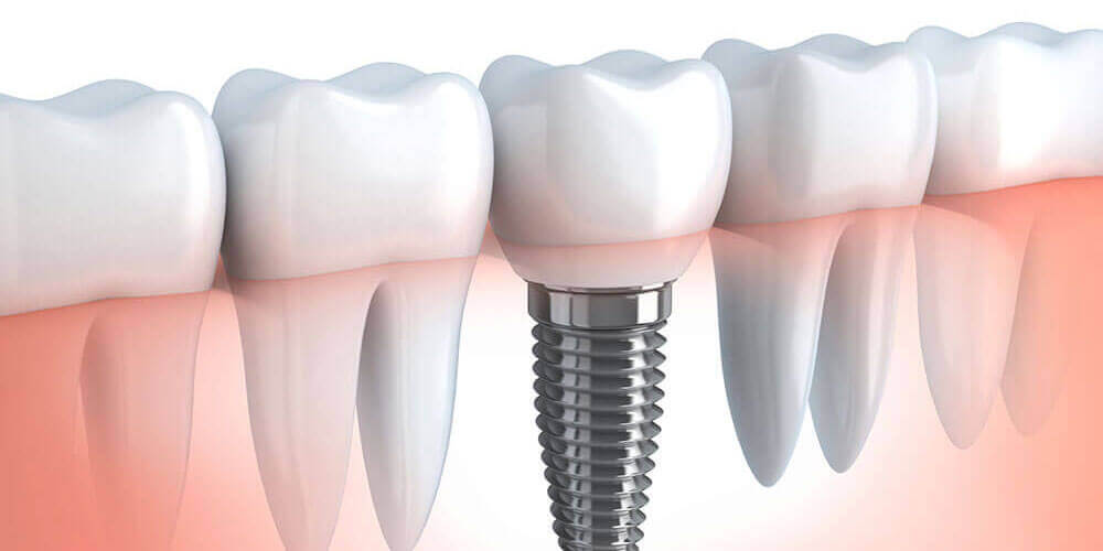 Dental Implants Leduc
