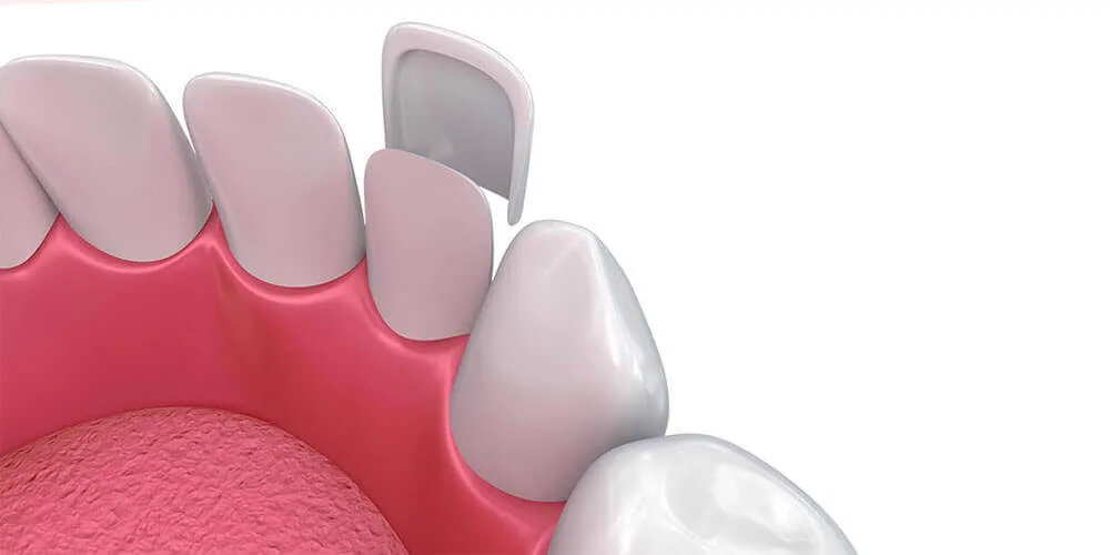 Dental Veneers