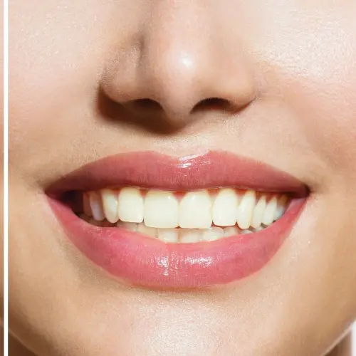 flashsmile-before-after-teeth-whitening-patientnews