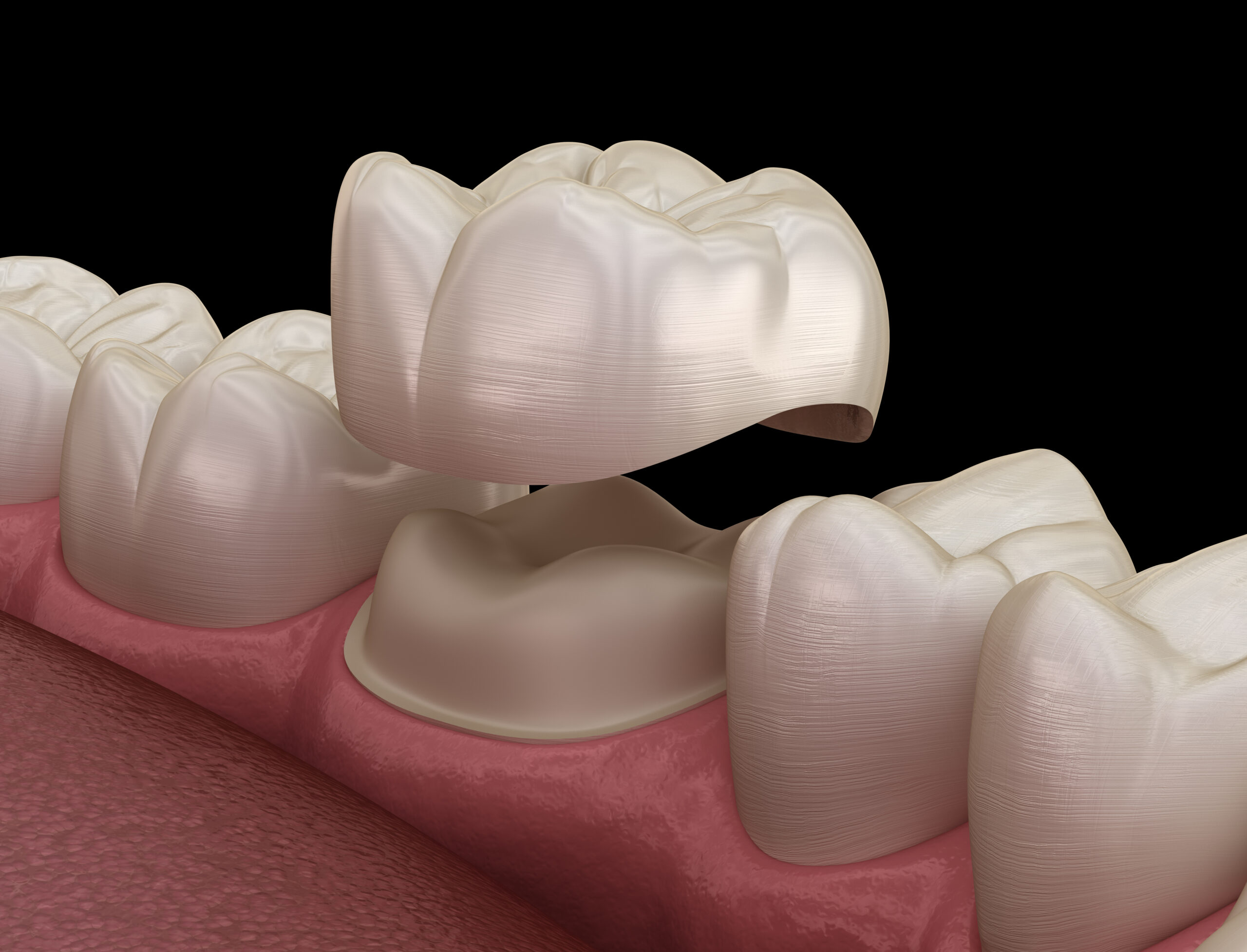 Lost Filling or Dental Crown in Leduc: When Do You Need Emergency Dental Care?