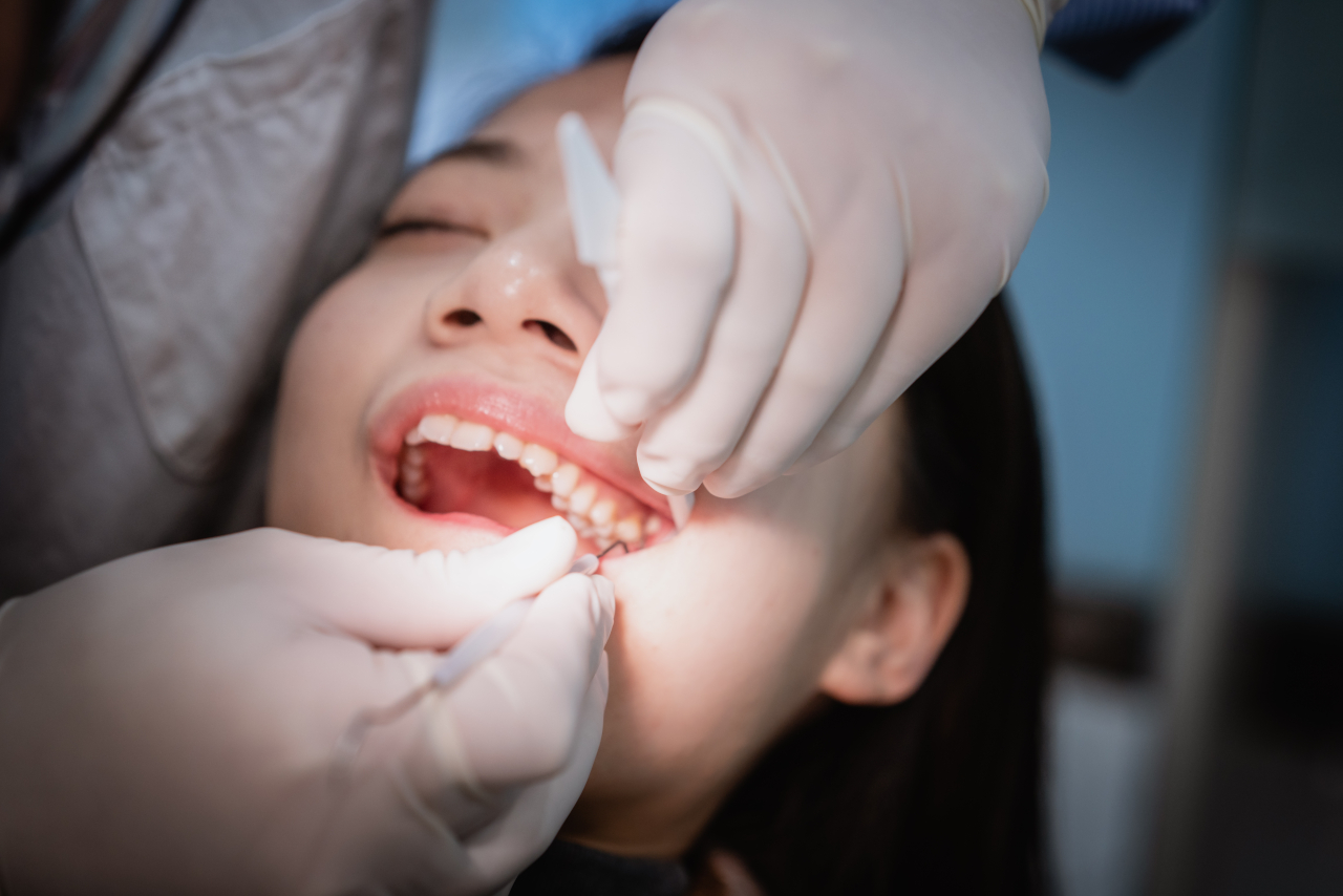 Emergency Tooth Extraction in Leduc: Signs You May Need Urgent Treatment